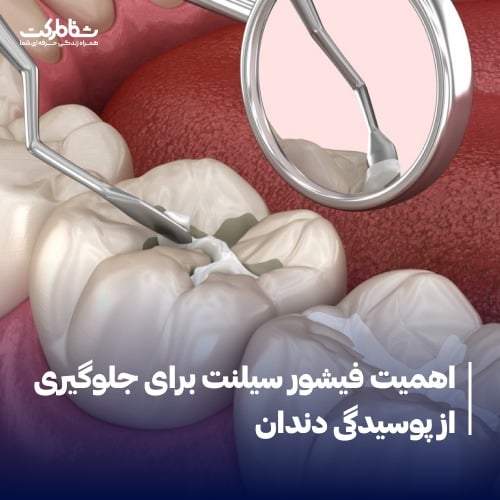 اهمیت فیشور سیلنت برای جلوگیری از پوسیدگی دندان: